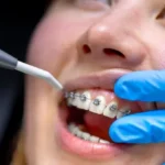Bayaran Braces di Klinik Kerajaan