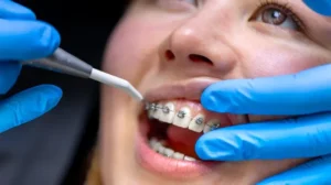 Bayaran Braces di Klinik Kerajaan 2025, Kos & Prosedur
